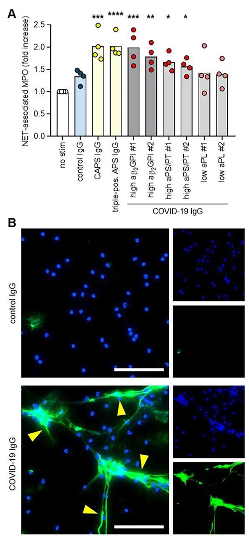 COVID-19患者IgG在体表推进从正常嗜中性粒细胞开释NET