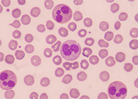 一种神秘颗粒被发现了！它能否成为败血症早筛标志物？